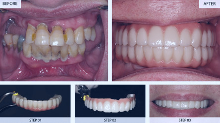 Dental Implants Results (Before & After) - 22 Cases